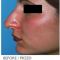 Rhinoplasty (Nose Job)