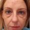 Korekcja powiek (Blepharoplastyka)
