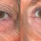 Blépharoplastie