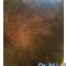 Trapianto capelli
