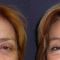 Forehead lift (Brow lift)