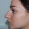 Rinoplastika (operacija nosa)