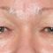 Korekcja powiek (Blepharoplastyka)