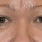Korekcja powiek (Blepharoplastyka)