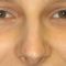Plastika nosu (Rhinoplastika)