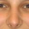 Plastika nosu (Rhinoplastika)