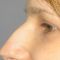 Plastika nosu (Rhinoplastika)