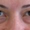 Korekcja powiek (Blepharoplastyka)