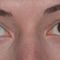 Korekcja powiek (Blepharoplastyka)