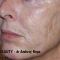 Facelift, SMAS Facelift