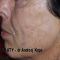 Facelift, SMAS Facelift