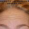 BOTOX®