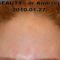 Nichtchirurgische Faltenbehandlung - BOTOX® / DYSPORT®