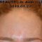 Nichtchirurgische Faltenbehandlung - BOTOX® / DYSPORT®