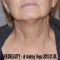 Mesotherapie (Revitalisierung von Gesicht, Hals, Dekolleté und Händen)
