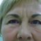 Blefaroplastie