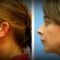 Ultrasonic liposuction