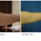 Ultrasonic liposuction