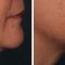 Ultherapy