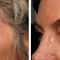 Ultherapy