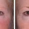 Ultherapy