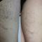 Spider veins laser removal (redness, birh marks)