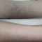 Spider veins laser removal (redness, birh marks)