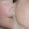 Spider veins laser removal (redness, birh marks)