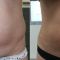 Laser Liposuction - SmartLipo
