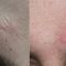 Laser Scar Treatment