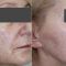 Laserowe zabiegi dermatologii estetycznej