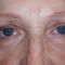 Operácia očných viečok (Blepharoplastika)
