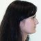 Operácia nosa (Rhinoplastika)