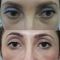 Kwas hialuronowy: Saypha, Restylane, Juvederm, Stylage