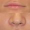 Kwas hialuronowy: Saypha, Restylane, Juvederm, Stylage