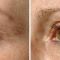 Thermage Skin Tightening