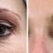 Thermage Skin Tightening