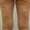 Laser procedures in aesthetic dermatology