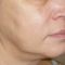 Laser procedures in aesthetic dermatology