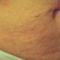 Treatment of cellulite