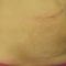 Treatment of cellulite