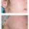 Laser hair removal