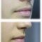 Laser hair removal