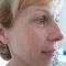 Fractional Laser Resurfacing