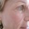 Fractional Laser Resurfacing