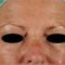 Fractional Laser Resurfacing