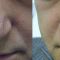 Spider veins laser removal (redness, birh marks)