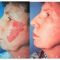 Spider veins laser removal (redness, birh marks)