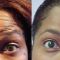 Botox/Dysport - Eliminar arrugas