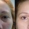 Cirugía de párpados (Blefaroplastia)
